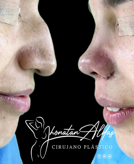 RINOPLASTIA-ULTRASONICA-GUAYAQUIL